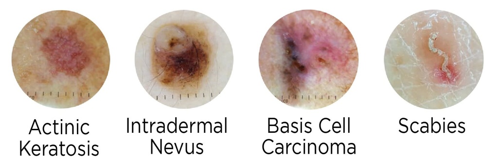 Illuco IDS 1100 Dermatoscope Kit 3 Includes Leather Pouch, 8mm Contact Plate & Universal Smartphone Clamp